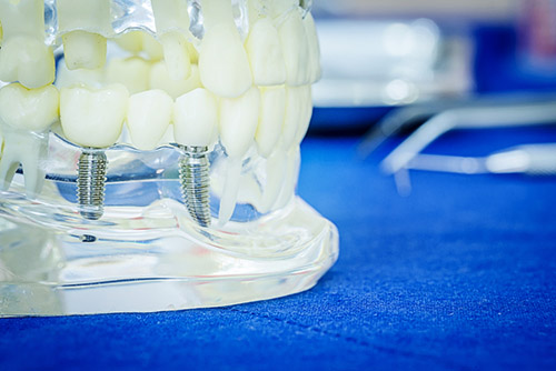 dental implants dunlap tn